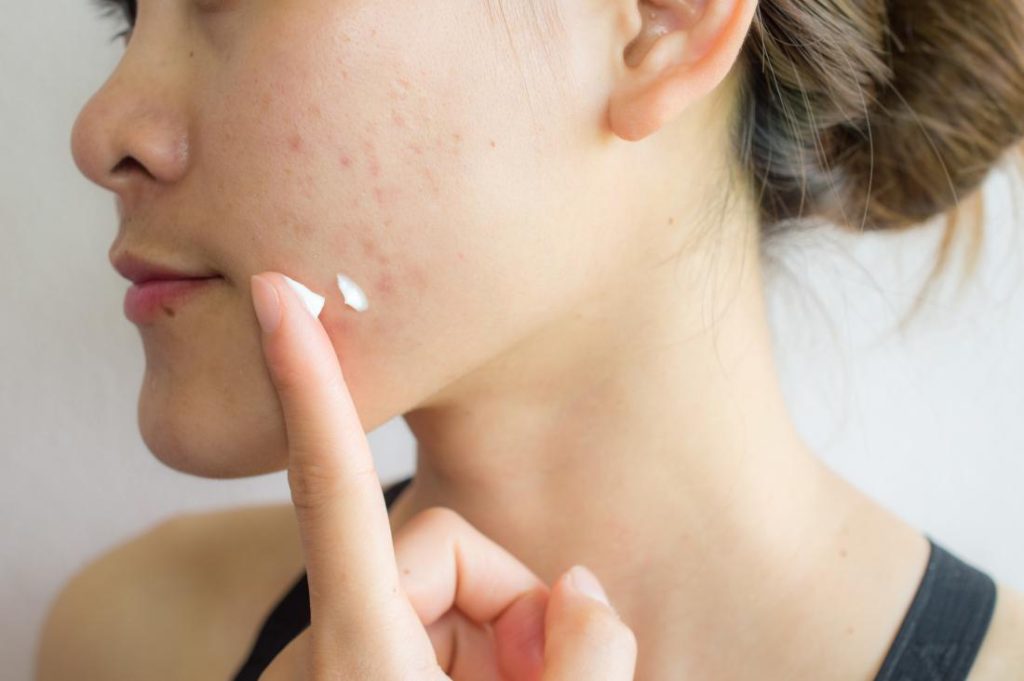 10+ Home Remedies For Acne Scar Removal That Actually Work