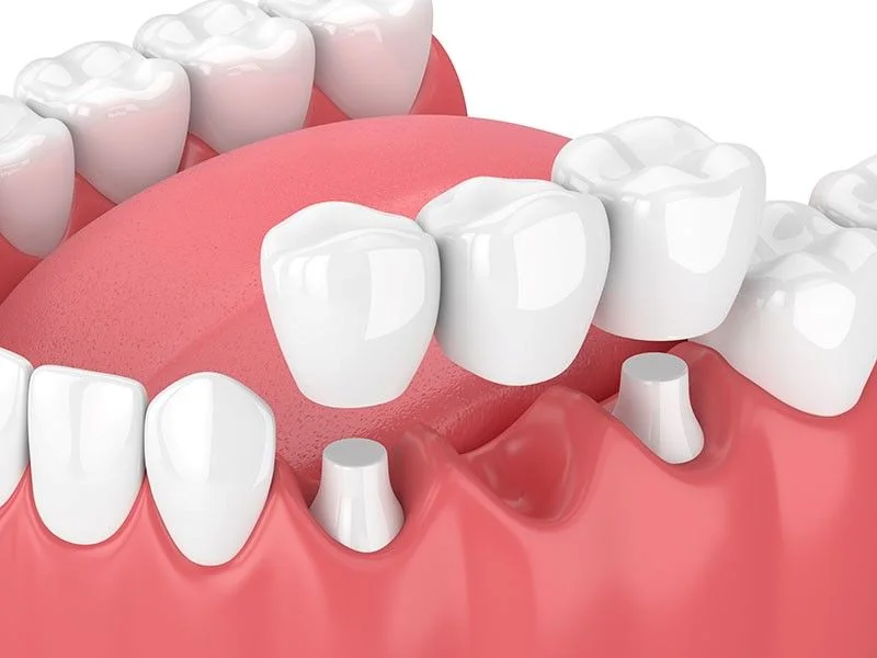dental bridges 