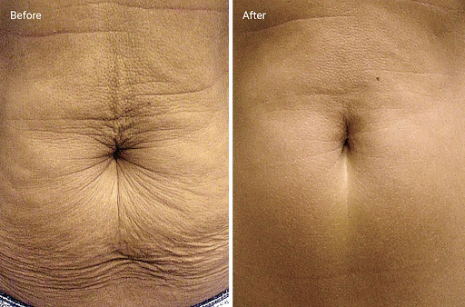 Radiofrequency treatment